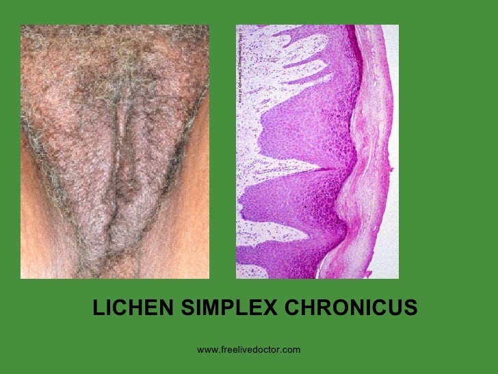 cunnilingus with lichen sclerosis Cunnilingus with lichen sclerosis